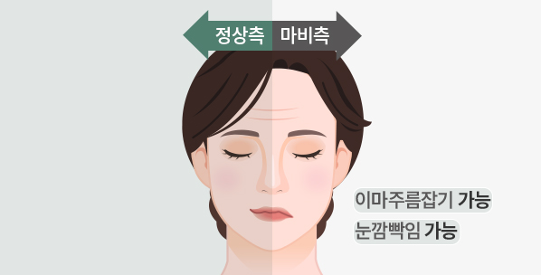 stroke 중추성 안면마비